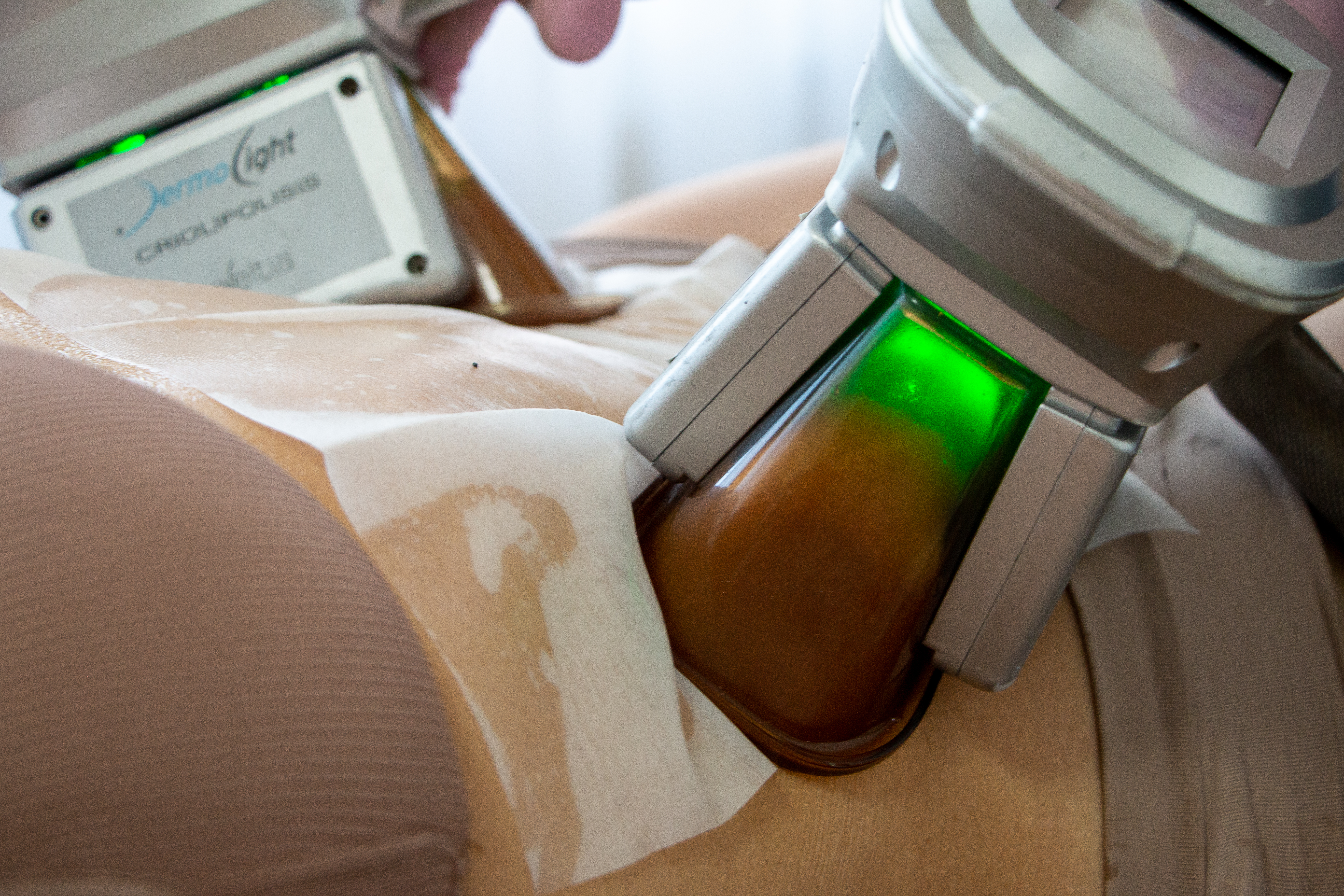 modal criolipólisis imagen